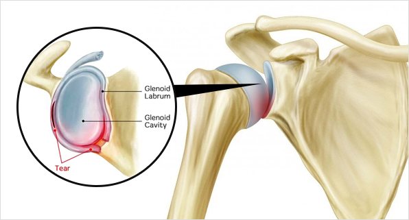 어깨 탈구란?