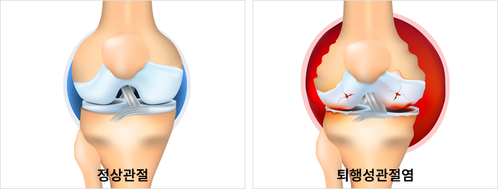 퇴행성 관절염이란?