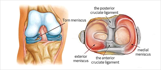 반월상 연골판 파열이란?