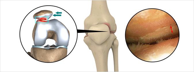 슬개골연골연화증이란?