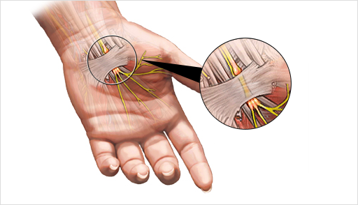 손목터널증후군이란?