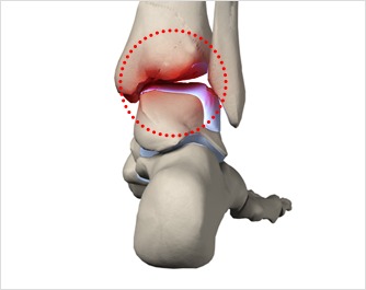 발목연골 손상이란?