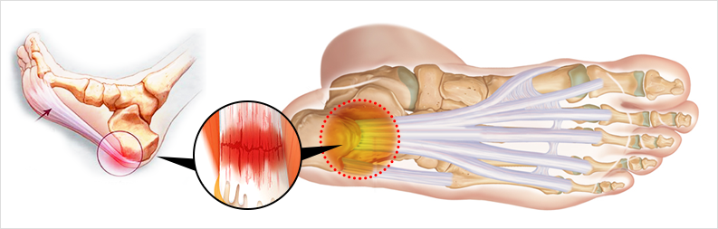 족저근막염이란?