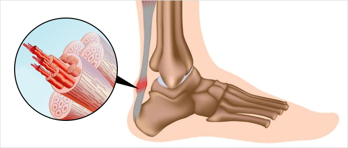 아킬레스건염이란?