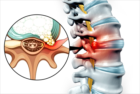 허리디스크란?