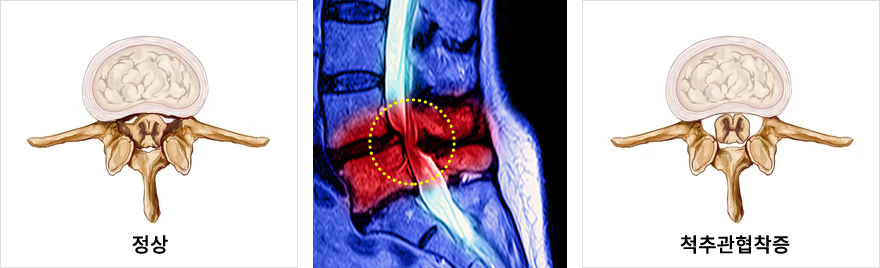 척추관 협착증이란?