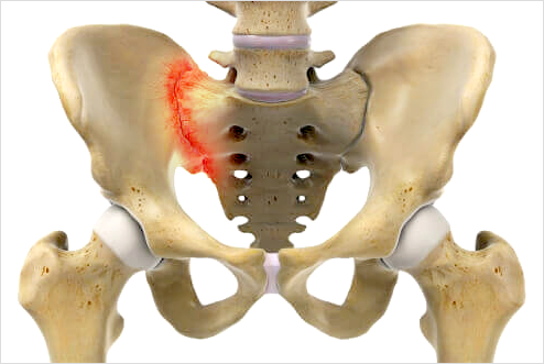 골반의 인대 손상이란?
