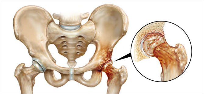 고관절 연골 손상이란?