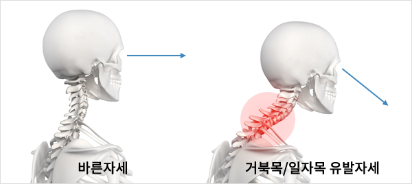 일자목/거북목이란?