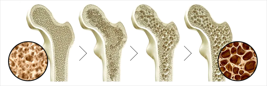 골다공증이란?