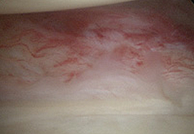 오십견 수술 전