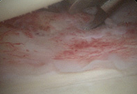 오십견 수술 중