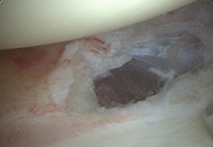 오십견 수술 후