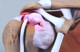 회전근개 파열이란?