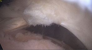 회전근개 파열 수술 전