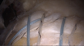 회전근개 파열 수술 후