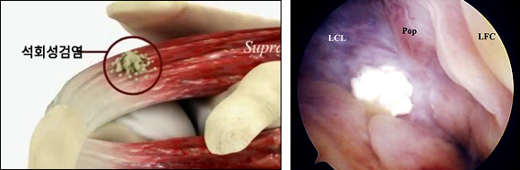 석회성건염이란?
