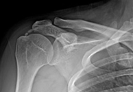 석회성건염 수술 전