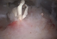 석회성건염 수술 중 제거 모습