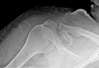 석회성건염 수술 후