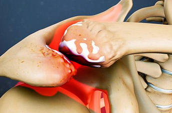 어깨 충돌증후군이란?