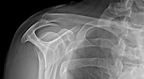 충돌증후군 수술 전 사진