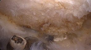 충돌증후군 수술 전 관절경