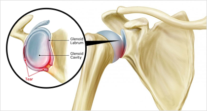 어깨 탈구이란?