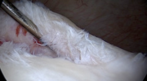 어깨 탈구에 의한 전방 관절와순 파열 수술 전