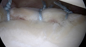 어깨 탈구에 의한 전방 관절와순 봉합술 후