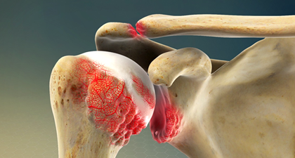 어깨관절염이란?