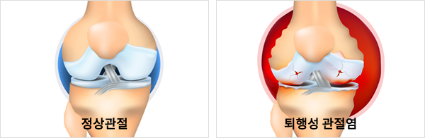 퇴행성 관절염이란?