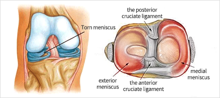 반월상 연골판 파열이란?