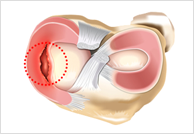 양동이 손잡이형 파열