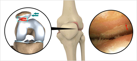 슬개골연골연화증이란?