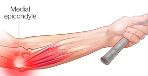 테니스엘보 / 골퍼스엘보란?