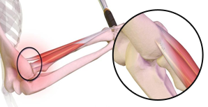 테니스엘보 / 골퍼스엘보란?