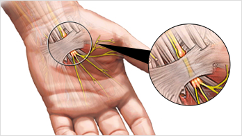 손목터널증후군이란?