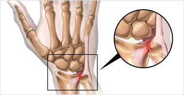 삼각섬유복합체 파열이란?