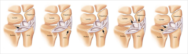 삼각섬유복합체 파열이란?