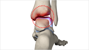 발목연골 손상이란?