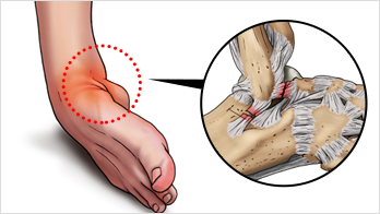 발목염좌 및 인대 손상이란?