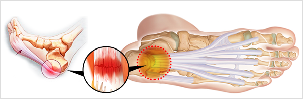 족저근막염이란?