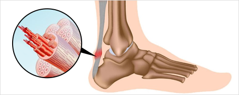 아킬레스건염이란?