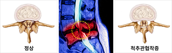 척추관 협착증이란?