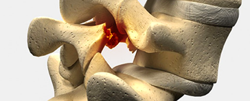 척추전방전위증이란?