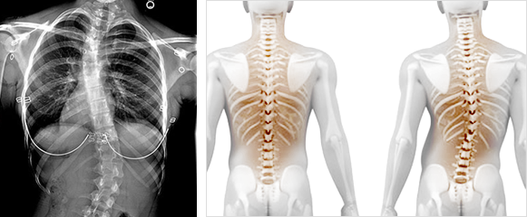 척추측만증이란?