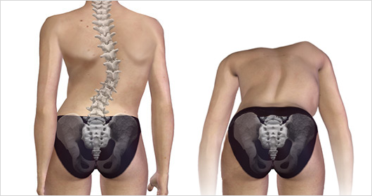 척추즉만증의 자가 검진