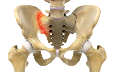 골반의 인대 손상이란?