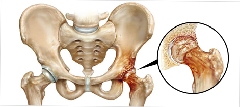 고관절 연골 손상이란?